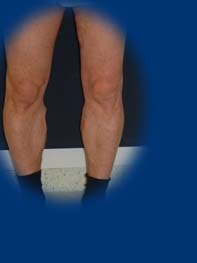 a láb belső visszér tünetei fotó a lábán visszeres trombus