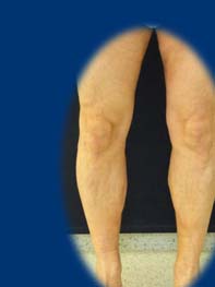visszérműtét hogyan kell végrehajtani visszér hogyan lehet a visszeres lábakat bekötni
