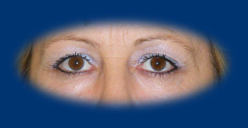 Felső szemhéjplasztika előtt jól látható az aszimmetria a két szemhéj között.