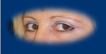 A szemhéjplasztika után még enyhe oedéma látható a szemhéjakon.