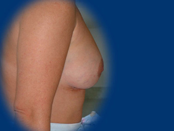 Az anatómiai implantátum utánozza a természetes női mellet.