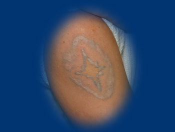 Tetoválást megpróbálták CO2 laserrel eltávolítani, de hegesedés maradt vissza.