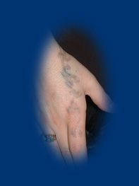 7. kezelés után. Itt egy régebbi tetoválásra tetováltak rá ismételten.