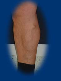 A jobb lábszáron egy nagy kiöblösödés látható a bőr alatt.
