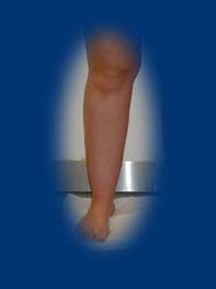 A jobb lábszár körkörösen meg van vastagodva a helyileg lerakódott zsírszövettől