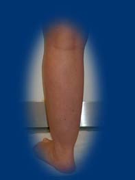 A lábszár külső oldal több zsírszövetet tartalmaz. Elfedi az izom formáját.