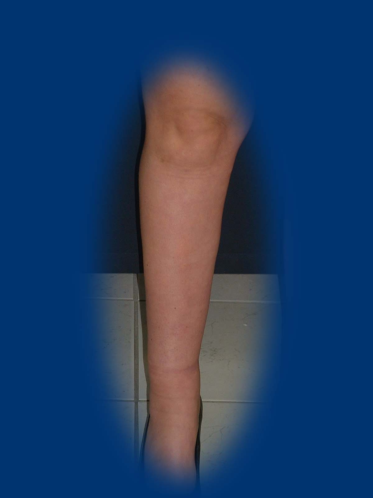 1,5 évvel a zsírszívást követően eltűnt a lábszár körkörös vastagsága.