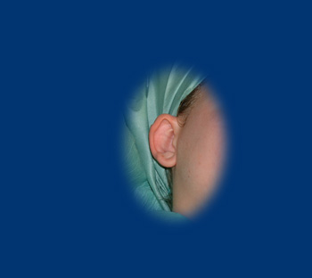 A jobb fülön is jól kivehetőek a fülplasztika indokát képező elváltozások.