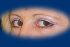 A szemhéjplasztika után még enyhe oedéma látható a szemhéjakon.