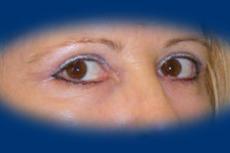 Ebből a szemszögből már jól látható a szemhéjplasztika korai eredménye.