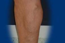 A jobb lábszáron egy nagy kiöblösödés látható a bőr alatt.